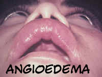 angioedema