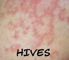 hives