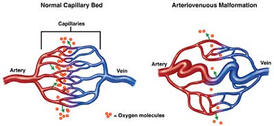 Capillaries and AVMs