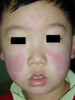 Fifth Disease