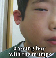a patient with the mumps