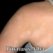 pityriasis alba