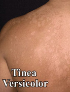 tinea versicolor
