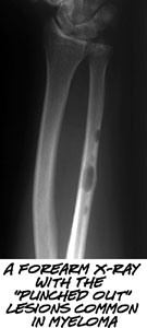 a forearm with lyitc lesions