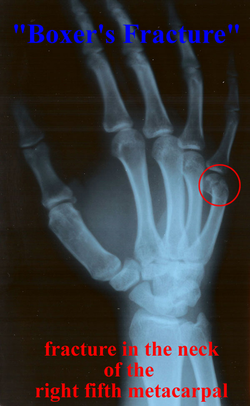 Annotated right hand x-ray
