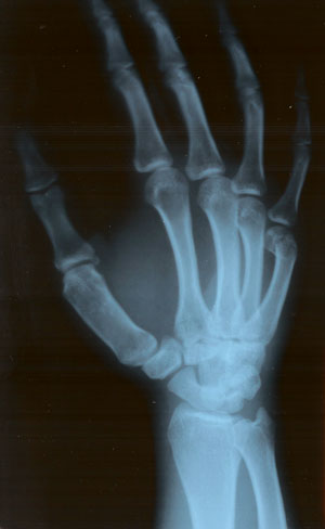 x-ray of the right hand