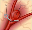An cerebral aneurysm clip
