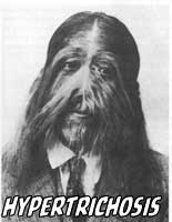 A Buddhist monk with congenital hypertrichosis A Buddhist monk with congenital hypertrichosis