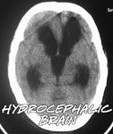 A brain with hydrocephalus A brain with hydrocephalus