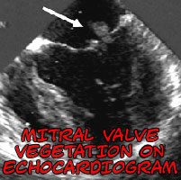 mitral valve vegetations