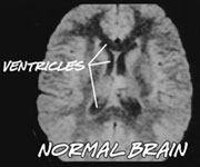 normal brain A normal brain