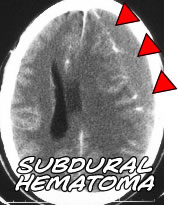 subdrual hematoma