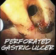 A perforated gastric ulcer