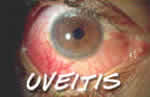 uveitis